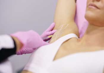 Under arm botox for sweat reduction